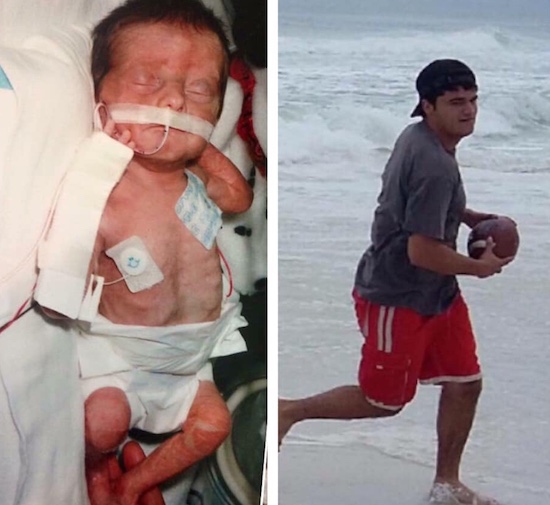 Side by side images of Ben as a preemie and grown up 